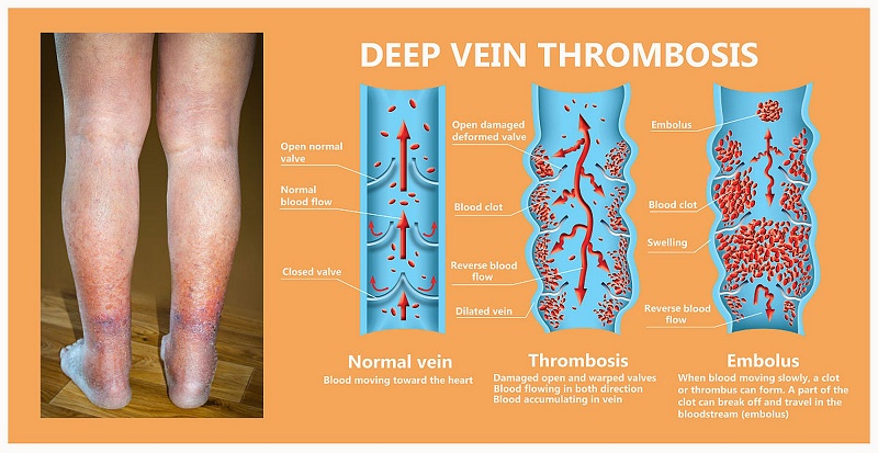 DVT prevention